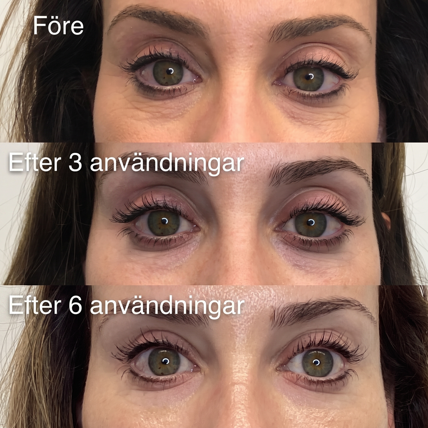 Aliver's Microneedle Patches