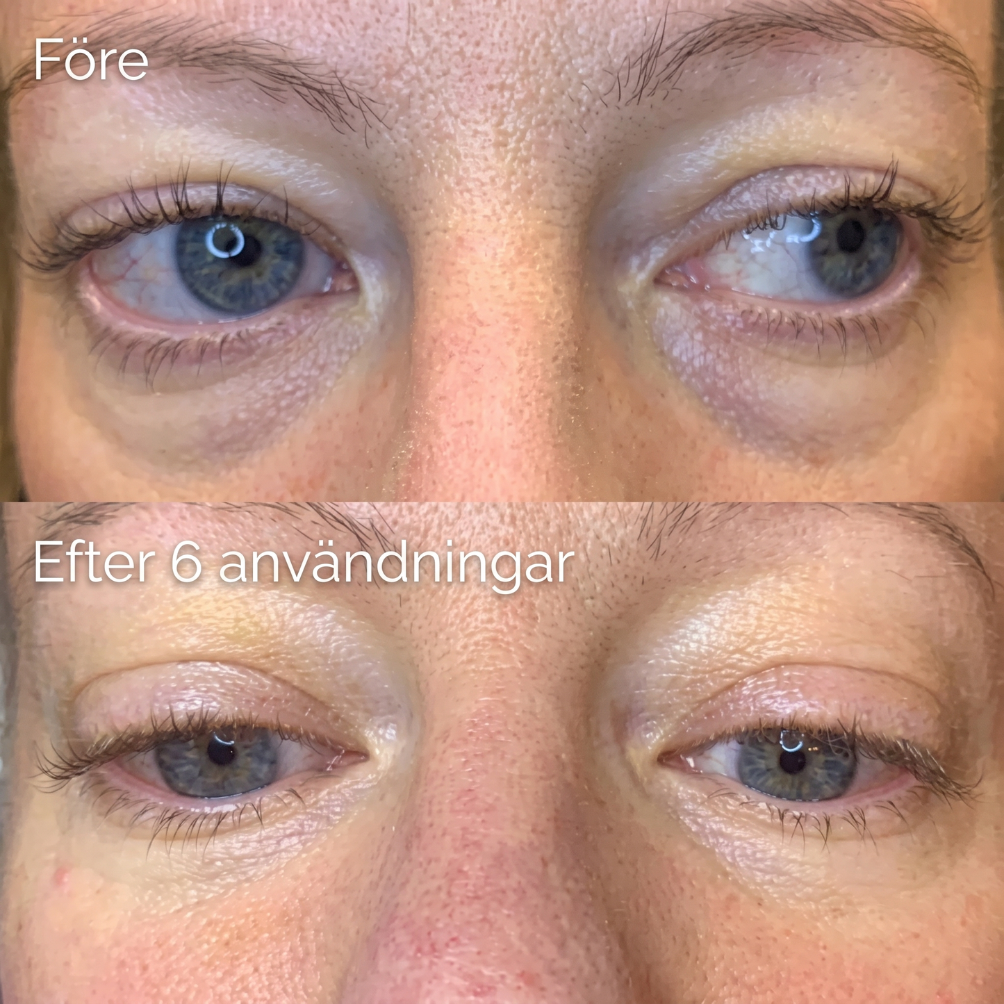 Aliver's Microneedle Patches