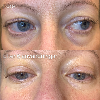 Aliver's Microneedle Patches